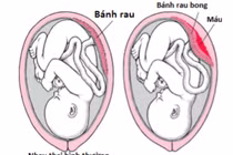 Phát hiện sớm rau bong non, sản phụ vượt cạn bình an