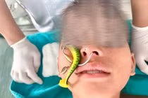 Đi câu, bệnh nhi 10 tuổi bị lưỡi câu găm vào sụn mũi 