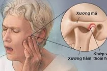 Địa chỉ vàng: Nơi khám chữa viêm khớp thái dương hàm tốt
