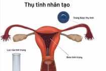 Cách chăm sóc thai thụ tinh ống nghiệm 3 tháng đầu