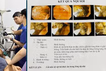 Ăn quả ngõa, người đàn ông 37 tuổi bị bã thức ăn nút dạ dày