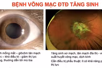 Khoảng 1/10 bệnh nhân đái tháo đường có nguy cơ mù lòa do bệnh võng mạc