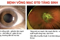 Khoảng 1/10 bệnh nhân đái tháo đường có nguy cơ mù lòa do bệnh võng mạc