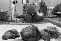 Uống thuốc nam, u xơ tử cung phát triển to như thai 6 tháng