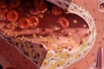 Chuyên gia chỉ cách kiểm soát mỡ máu tránh bệnh tim mạch