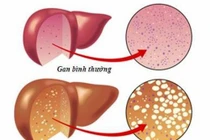 FDA chấp thuận thuốc điều trị gan nhiễm mỡ không do rượu đầu tiên 