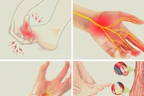 Bác sĩ mách cách khắc phục các bệnh gây tê bì chân tay