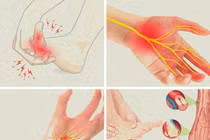 Bác sĩ mách cách khắc phục các bệnh gây tê bì chân tay