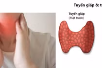 U tuyến cận giáp và những điều cần biết