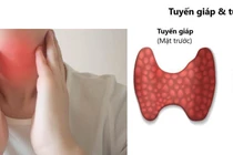 U tuyến cận giáp và những điều cần biết