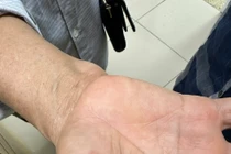  Ấu trùng giun đũa chó mèo nổi trên tay bệnh nhân.