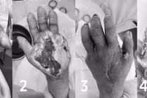 Từ vết ngứa nhỏ, người phụ nữ bị hoại tử, phải tháo ngón tay