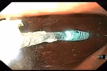 Bàn chải đánh răng trong dạ dày bệnh nhân