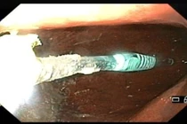 Bàn chải đánh răng trong dạ dày bệnh nhân