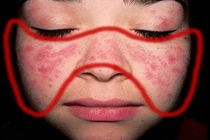 Bác sĩ chỉ cách chung sống với bệnh lupus ban đỏ?