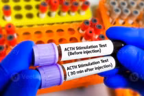 Xét nghiệm phát hiện suy tuyến thượng thận do điều trị Corticoid kéo dài