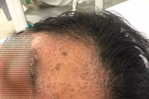 Cô gái 17 tuổi mê sảng, suy đa cơ quan do mắc thủy đậu