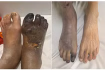 Địa chỉ vàng: Bệnh viện chữa trị thiếu máu chi dưới mạn tính