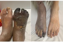 Mùa lạnh, cẩn thận bệnh viêm tắc động mạch chi gây tàn phế