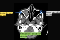 Cẩn thận nấm xoang phá hủy hốc mắt, gây viêm não