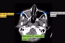 Cẩn thận nấm xoang phá hủy hốc mắt, gây viêm não
