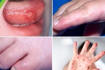 Địa chỉ vàng: Bệnh viện khám và điều trị bệnh tay chân miệng