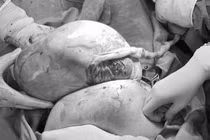  Bác sĩ bất ngờ khi chào đón cặp song sinh còn nguyên trong bọc ối