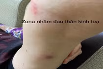 Nhiều người bị những bệnh lý hay gặp dễ nhầm lẫn với đau xương khớp