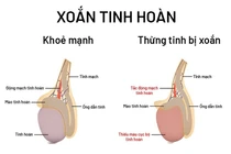 Đang ngủ tỉnh giấc vì đau, thanh niên 16 tuổi bị xoắn tinh hoàn hoại tử