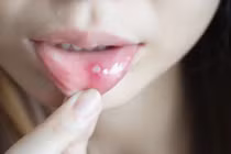 Bác sĩ mách cách phòng chống nhiệt miệng đơn giản