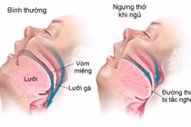 Bác sĩ chỉ cách nhận biết và điều trị hội chứng “ngưng thở khi ngủ”