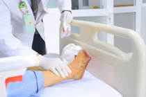 Ngâm chân nước nóng, người phụ nữ bị hoại tử phải tháo khớp ngón