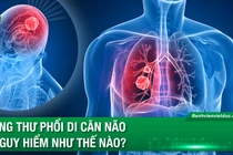 Ung thư phổi di căn não nguy hiểm như thế nào?