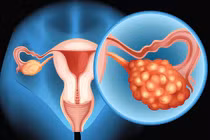 Dấu hiệu ung thư buồng trứng không nên bỏ qua