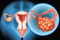 Dấu hiệu ung thư buồng trứng không nên bỏ qua