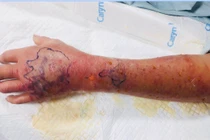 Bé 3 tuổi cắn, người đàn ông hoại tử cánh tay vì viêm mô tế bào