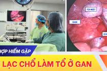 Hy hữu: Thai lạc chỗ làm tổ ở gan