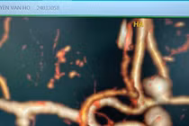 Hoa mắt ngã quỵ người đàn ông hôn mê vì vỡ túi phình mạch máu lớn