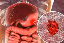 Ung thư dạ dày liên quan đến HP do ăn uống không lành mạnh