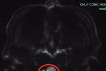 Tưởng chóng mặt vì say rượu... ai ngờ liệt do đột quỵ não