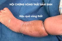 Tưởng bé bụ bẫm có ngấn... nào ngờ mắc hội chứng vòng thắt bẩm sinh