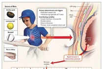 Ngừng tim đột ngột liên quan đến hoạt động thể thao, do đâu?