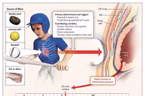 Ngừng tim đột ngột liên quan đến hoạt động thể thao, do đâu?