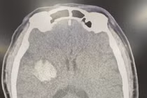 Đột quỵ não nguy kịch do tự uống “an cung ngưu hoàn hoàn”