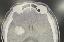 Đột quỵ não nguy kịch do tự uống “an cung ngưu hoàn hoàn”