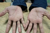 Ngứa da, nổi mụn nước... bất ngờ được chẩn đoán bệnh ghẻ