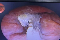 Lấy xương dài 2,5 cm mắc trong phế quản bệnh nhân 3 năm