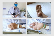 Rùng mình với tứ chi người đàn ông bị biến dạng khớp do bệnh Gout