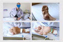 Rùng mình với tứ chi người đàn ông bị biến dạng khớp do bệnh Gout