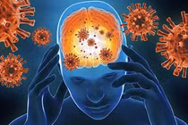 Tưởng đột quỵ nào ngờ viêm não tự miễn thể hiếm gặp